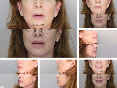 Lip Lift Before and After | New York Plastic Surgeon Dr. Linkov Lip Surgery, Lip Lift, Facial Plastic, Scar Tissue, Before And After Pictures, After Photos, Plastic Surgeon, Medical Professionals, Surgery