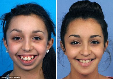 Ellie Jones, 20, from Rhyl, Wales, was born with a congenital facial deformity that meant her teeth were not aligned. She visited a maxillofacial surgeon who helped transform her life over the next six years. Braces Before And After, Dental Ideas, After Braces, Natural Teeth Whitening Diy, Orthognathic Surgery, Hair Implants, Jaw Surgery, Facial Surgery, Kedokteran Gigi