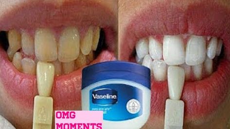 Membakar Lemak Perut, Maquillage Yeux Cut Crease, Teeth Whitening Homemade, Teeth Whitening Remedies, Teeth Whitening Diy, Brow Tutorial, Teeth Whitening Toothpaste, Loose Tooth, Whiten Teeth