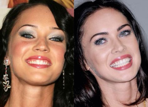 Megan Fox Before/After Veneers Celebrity Teeth, Dental Makeover, Cosmetic Dentistry Veneers, Hollywood Smile, Celebrity Smiles, Veneers Teeth, Laser Teeth Whitening, Dental Veneers, Botox Fillers