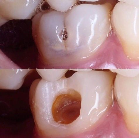 Tooth Caries, Loose Teeth, Dental Photos, Dental World, Tooth Cavity, Longevity Diet, Molar Tooth, Veneers Teeth, Dental Fun