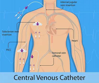 Central Lines Nursing, Central Line Catheter, Picc Line Nursing, Central Line Nursing, Iv Certification, Infusion Nurse, Central Venous Catheter, Nursing Cheat, Interventional Radiology