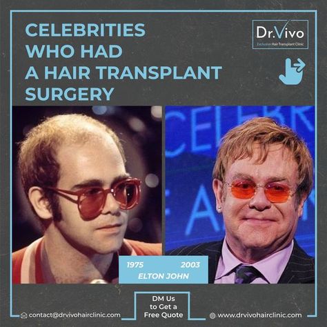 🎯Many celebrities have resorted to hair implants to fight their baldness problem. From movie stars to athletes, singers, and comedians, all have opted for this permanent solution to regain dense hair and correct an uneven hairline. Put an end to your never-ending problems with baldness at @dr.vivohairclinic ! ✉️ DM to Get a FREE Quote! #drvivohairclinic #hairtransplantturkey #drvivo #exclusivehairtransplant #baldnesscure #hairtransplantation #hairimplantturkey #hairtransplantsurgery Uneven Hairline, Dense Hair, Hair Transplant Before And After Men, Hairtransplant Men, Hair Implants, Hair Transplant Cost, Hair Transplant Surgery, Hair Clinic, From Movie