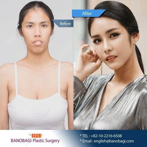 Korean Surgery, Kpop Plastic Surgery, Jaw Reduction Surgery, V Line Surgery, Gangnam Seoul, Plastic Surgery Fail, Korean Plastic Surgery, Plastic Surgery Gone Wrong, Face Surgery