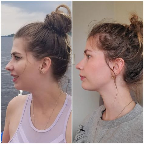 I've posted my before/after taken from the front, but also want to showcase how jaw surgery can drastically change the side profile in terms of recession + a weak chin. DJS for overbite, 3-piece Lefort 1, genioplasty, septoplasty. : PlasticSurgery Overbite Before And After, Weak Chin, Face Plastic Surgery, Nose Surgery Rhinoplasty, Face Makeover, Chin Filler, Face Transformation, Chin Implant, Rhinoplasty Nose Jobs