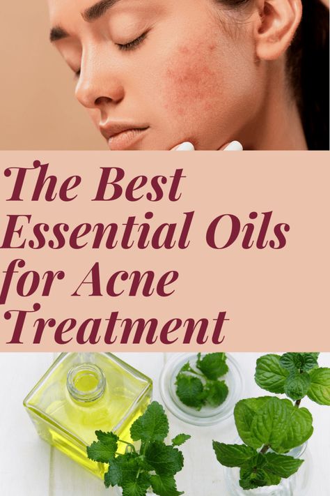 Essential Oils For Acne, Oils For Acne, Home Remedy For Cough, Acne Oil, Cold Sores Remedies, Essential Oils For Skin, Natural Sleep Remedies, Natural Cold Remedies, Natural Cough Remedies