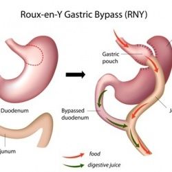 Bariatric surgery: Do people gain back the weight that they've lost and, if so, how quickly does that happen? Dumping Syndrome, Gastric Band, Bariatric Surgeon, Sleeve Gastrectomy, Sleeve Surgery, Digestive Juice, Bypass Surgery, Best Hospitals, Gastric Bypass