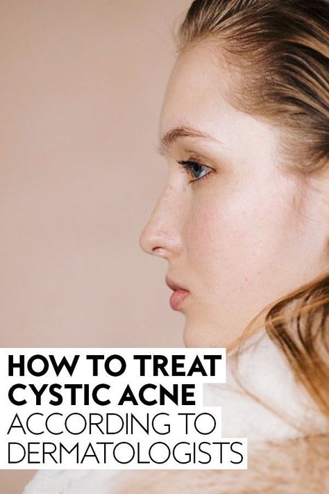 These are the best cystic acne treatments according to dermatalogist for you chin, back, and neck. #SkinCare #AcneScars #SelfCare #CysticAcne | InStyle Cystic Acne On Chin, Period Health, Treating Cystic Acne, Cystic Pimple, Face Mapping Acne, Acne Treatments, Blood Pressure Medications, Play Free Online Games, Hormonal Acne