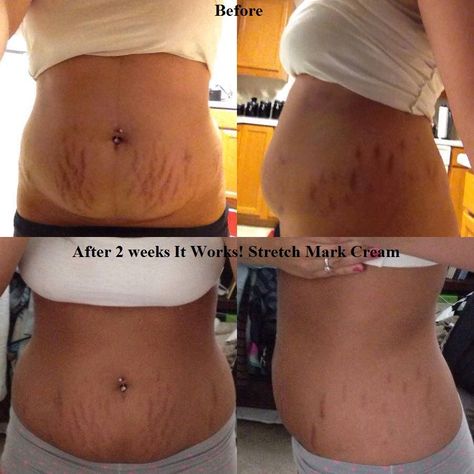 Pamper Your Skin - Shop Stretch Mark Creams Now! 🌟 stretch mark on neck, stretch mark on knee, stretch mark on hips #stretchmarks #selfcare #healthyskin Whiteheads Removal, Best Peel Off Mask, Pimple Solution, Stretch Mark Remedies, Marks Cream, Skincare Secrets, Acne Help, Stretch Mark Removal, Stretch Mark Cream