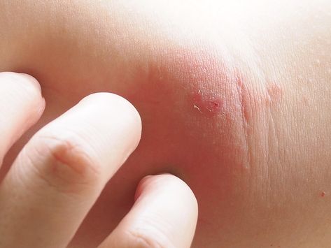 A woman thought she may have had a simple bug bite in her groin  but it was really a baby fly burrowed into her skin Bot Fly, Trip To Belize, Bug Bite, Bug Bites, Belize, Bugs, A Woman, Skin, 10 Things