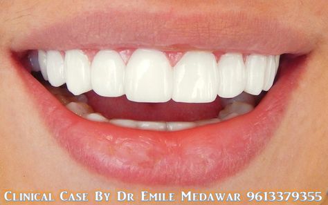 Hollywood Smile Veneers, Dental implant in Lebanon, Style Dental Clinic, Dentist in Beirut Lebanon, 00961 3 379355 Teeth Aesthetic, Pretty Teeth, Corps Idéal, Veneers Teeth, Beautiful Teeth, Straight Teeth, Porcelain Veneers, Perfect Teeth, Nice Teeth