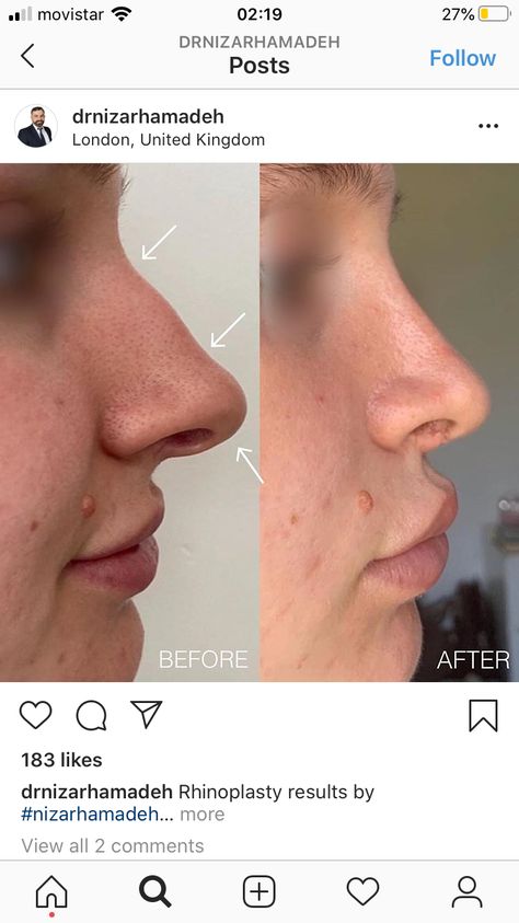 Big Nose Rhinoplasty, Nose Rhinoplasty, Rhinoplasty Nose Jobs, Button Nose, Nose Shapes, Smink Inspiration, Big Nose, Big Noses, Nose Job