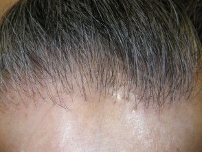 Frontal fibrosing alopecia | DermNet NZ Scarring Alopecia, Frontal Fibrosing Alopecia, Alopecia Hairstyles, Traction Alopecia, Androgenetic Alopecia, Hair Density, Hair Follicle, Facial Skin, Facial Skin Care