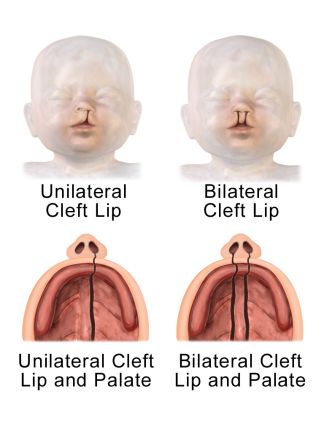 Cleft lip and palate awareness. – Bryony – Perfectly Imperfect Cleft Lip And Palate Awareness, Obstetrics Nursing, Maxillofacial Surgery, Cleft Lip And Palate, Cleft Palate, Comparative Analysis, Cleft Lip, Lip Drawing, Medical Student Motivation