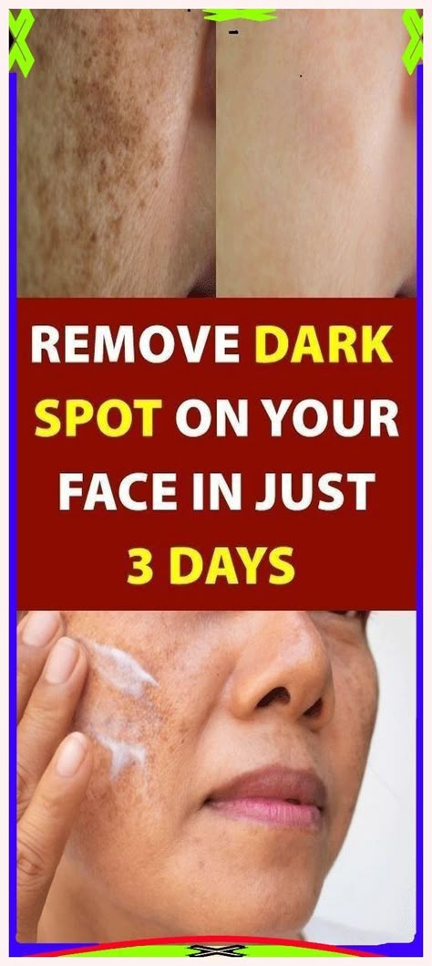 Thanks a bunch. Terrific information! Dark Spot Removal, Natural Botox, Brown Spots On Skin, Spots On Skin, Age Spot, Dark Spots On Face, Eliminate Wrinkles, Spot Remover, Brown Spots On Face