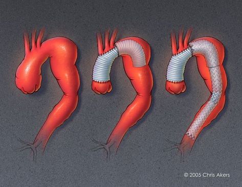 ascending aortic aneurysm | ... Repair of an Ascending, Arch, and Descending Thoracic Aortic Aneurysm Vascular Surgery, Elephant Trunk, Annual Meeting, Surgery, Trunk, Arch, Elephant, Repair