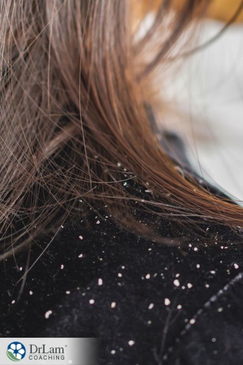 The most common symptoms of dandruff is an itchy, irritated scalp and small flakes sloughing off of your skin. Not only is the skin condition uncomfortable, but it can also be socially embarrassing when dead skin flakes show up in your hair or on your clothes. Natural Dandruff Remedy, Dandruff Remedy, Flaking Skin, Adrenal Health, Anti Dandruff Shampoo, Itchy Scalp, Skin Condition, Baby Massage, Skin Disorders