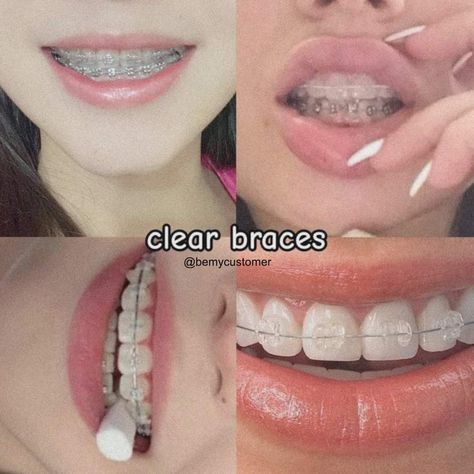 Ceramic Braces Color Bands, Clear Braces With Color Bands, Brackets Aesthetic, Perfect Teeth Braces, White Braces, Silver Braces, Ceramic Braces, Cute Braces Colors, Types Of Braces