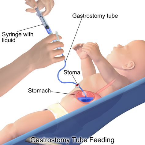 Difference Between G-tube and J-tube | Difference Between Gastrostomy Tube, Feeding Tube Awareness, Nursing Informatics, Cpt Codes, Anatomy Science, Medical Coder, How To Code, Medical Student Motivation, Medical Billing And Coding