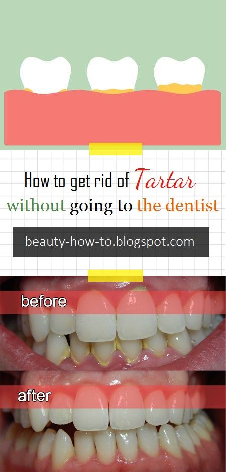 How to get rid of tartar without going to the dentist Toddler Tooth Decay, Going To The Dentist, Tartar Removal, Coconut Oil For Teeth, Skin Tags, Hygiene Care, Stronger Teeth, Oral Care Routine, Gum Care