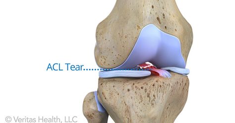 Tears or ruptures of the anterior cruciate ligament (ACL) are a common type of knee injury. Learn how typical ACL injuries occur. Ligaments Of The Knee, Medial Knee Pain, Acl Injury, Knee Ligaments, Anterior Cruciate Ligament, Kyle Schwarber, Cubs Win, Acl Tear, Cruciate Ligament