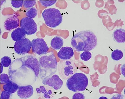 Pleural fluid a. lymphoma cells b. lymphocytes c. neutrophils d. macrophages d-1. macrophage with hemophagocytosis present Medical Laboratory Technician, Abnormal Cells, Laboratory Technician, Medical Laboratory Science, Electron Microscope, Lab Tech, Body Fluid, Laboratory Science, Medical Laboratory