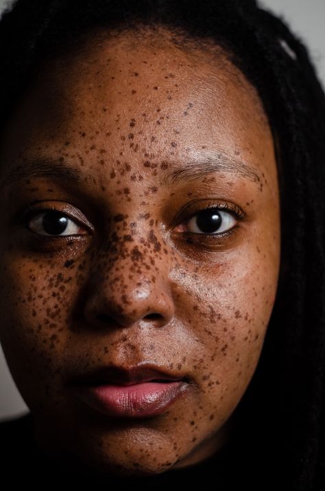 And the catagory is FACE!! Because this beautiful girl is serving face with her lovely freckles Heavy Freckles, Girl With Moles On Face, Black Girls With Freckles, Moles On Face, Cute Freckles, Freckles Girl, Beautiful Freckles, Freckle Face, Ginger Smoothie