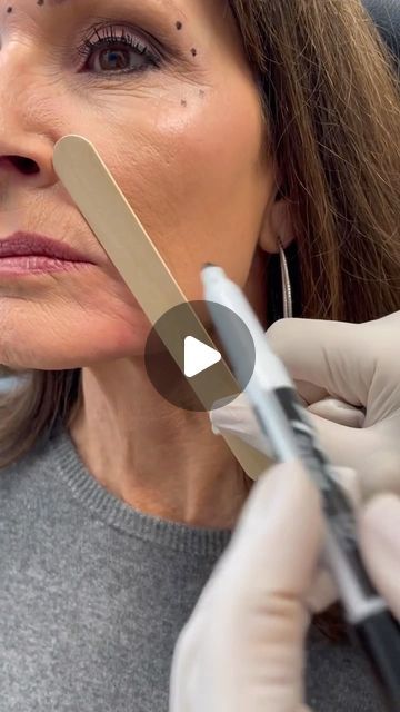 Lip Flip Vs Filler, Frown Lines Around Mouth, Botox Around Mouth, Lip Line Filler, Botox Business, Facial Muscles Anatomy, Upper Lip Wrinkles, Botox Injection Sites, Aesthetics Business