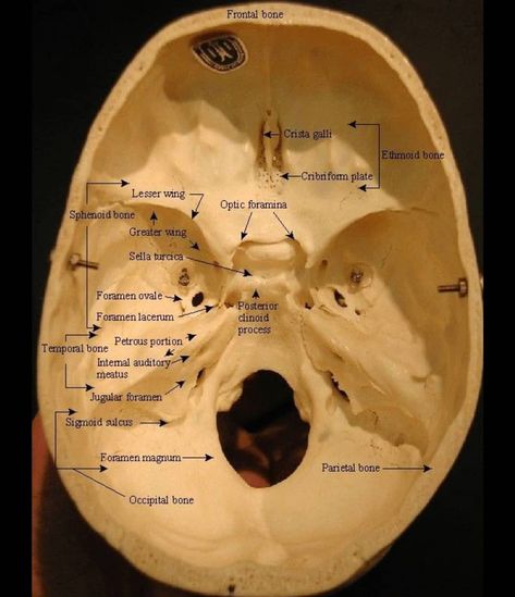 Key Facts. Anterior cranial fossa. Content: frontal lobe of the brain, olfactory bulb, olfactory tract. Bones: orbital surface of the temporal bone, lesser wing of the sphenoid bone. Landmarks: anterior ethmoidal foramen, cribriform foramina, jugum sphenoidale, foramen caecum, frontal crest... Neurosurgery Study, Temporal Bone, Basic Anatomy, Anatomy Bones, Skull Anatomy, Forensic Anthropology, Study Stuff, Dental Hygiene School, Medicine Notes