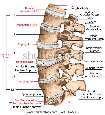 Spine disc problems, degenerative lumbar disc disease, degenerative disc disorder, degenerated disk, bulging disk, herniated disk, thinning disk, disk degeneration with osteophyte formation Lumbar Disc, Back Bone, Bulging Disc, Disk Herniation, Human Body Anatomy, Spine Health, Spine Surgery, Muscle Anatomy, Human Skeleton