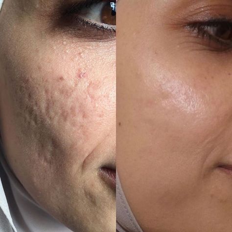 Laser Scar Removal, Laser Acne Scar Removal, Fibroblast Plasma, Full Cheeks, Skin Tightening Procedures, Skin Tightening Treatments, Eyelid Lift, Acne Scarring, Acne Scar