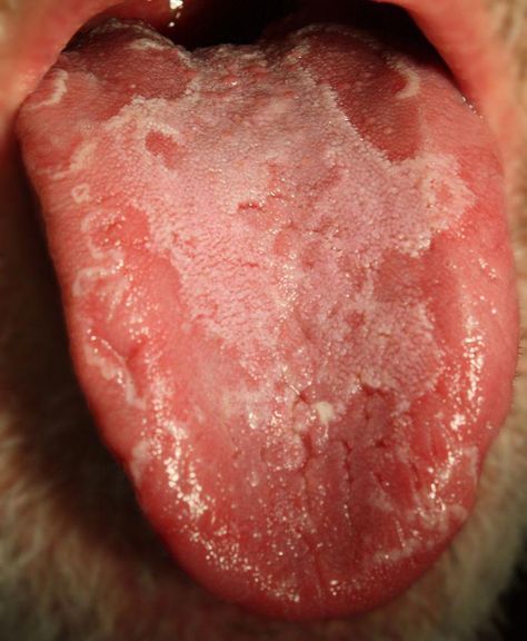 Computer simulations are shedding light on a mysterious condition that causes red patches on the tongue that resemble a map, known as Skin Fungus, Red Moles, Remove Skin Tags Naturally, Womens Health Care, Natural Hair Mask, Women Health Care, Red Patch, Stained Teeth, Nutritional Deficiencies