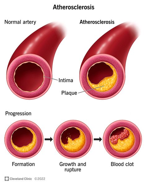 Clogged Arteries, Cognitive Behavior, Medical School Essentials, Heart Problems, Health Articles, Blood Vessels, Blood Flow, How To Stay Healthy, Disease