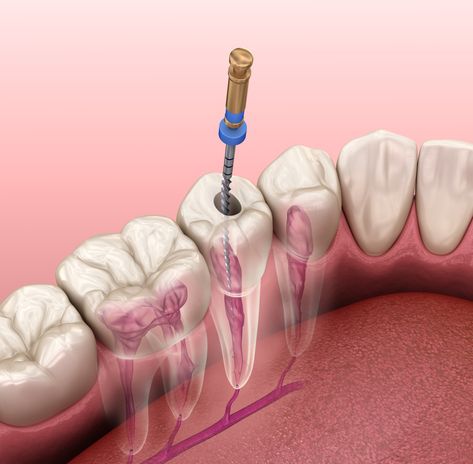 Teeth Illustration, Dental Decay, Dental Fillings, Restorative Dentistry, Emergency Dentist, Tooth Pain, Dental Procedures, Dental Problems, Root Canal