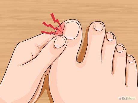 Toenail Pain, Nail Remedies, Nail Problems, Ingrown Toenail, Nail Infection, Ingrown Nail, Fungal Nail, Ingrown Toe Nail, Nail Fungus