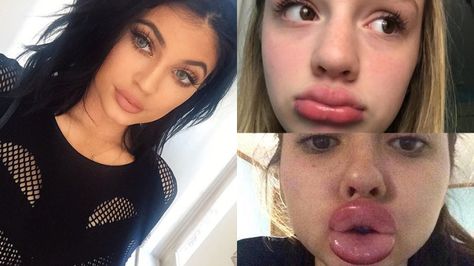 kylie-jenner-lip-challenge-instagram-twitter Kylie Jenner Challenge, Kylie Jenner Lip Challenge, Kylie Jenner Lip, Challenge Instagram, Kylie Jenner Lips, Lip Plumping, Diy Lips, Keeping Up With The Kardashians, Word Of Mouth