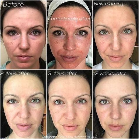 Vampire Facial | Platelet Rich Plasma Facial | Dr. Kass Plasma Facial, After Microneedling, Facial Before And After, Dermapen Microneedling, Forehead Acne, Vampire Facial, Laser Resurfacing, Skin Structure, Anti Aging Treatments