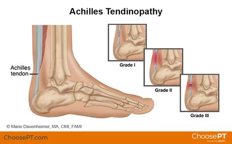 Guide | Physical Therapy Guide to Achilles Tendinopathy | Choose PT Tens Unit Placement Charts, Tens Unit Placement, Achilles Tendinopathy, Achilles Pain, Sports Physical Therapy, Tens Unit, Achilles Tendon, Ten Unit, Lower Extremity