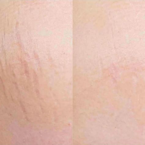 Laser Stretch Mark Removal – Does It Really Work? Laser Stretch Mark Removal, Whiteheads Removal, Remove Skin Tags Naturally, Stretch Mark Remedies, Laser Skin Resurfacing, Fractional Laser, Laser Resurfacing, Best Lotion, Stretch Mark Removal