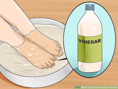 fungal nail pedicure Brittle Toenails, Clean Toenails, Yellow Toenails, Yellow Toe Nails, Toenail Fungal Infection, Remove Yellow Stains, Nail Discoloration, Nail Remedies, Nail Infection