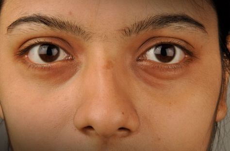 If you notice puffy eyelids, blemishes and dark circles underneath the eyes, all other conditions ruled out, you could have a slight sensitivity to dairy, which causes the release of inflammatory chemicals that can cause these symptoms to appear. Adding a spice like turmeric, often used in Indian cooking, to salad dressings and marinades, to give the skin the ultimate inflammation fighting boost it needs. It acts like a police officer that patrols inflammation. Swollen Eyes, Eye Cream For Dark Circles, Anti Aging Eye Cream, Concealer For Dark Circles, Remove Dark Circles, Under Eyes, Dark Circles Under Eyes, Dark Under Eye, Dark Circle