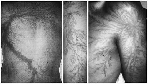 Lightning Struck Scars, Lichtenberg Scars, Lightning Scar Reference, Lightning Strike Scar, Lichtenberg Scar, Lightning Scar Drawing, Struck By Lightning Scar, How To Draw Burn Scars, Districts Of Panem