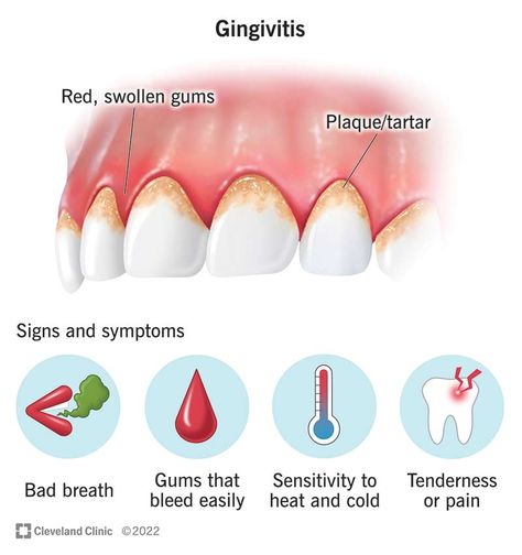 Reverse Receding Gums, Grow Back Receding Gums, Remedies For Tooth Ache, Dental Posters, Swollen Gum, Loose Tooth, Perfect Teeth, Periodontal Disease, Receding Gums