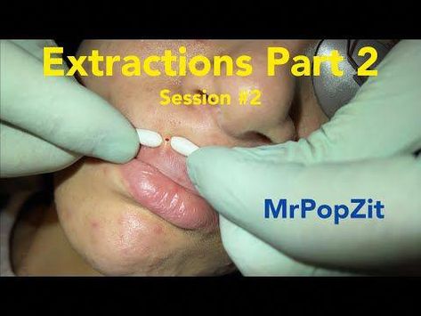 https://amzn.to/3rXImA5Hey guys click the link above to help keep my channel free. You don’t have to buy, even clicks help! If you are in medicine and stand ... Lip Blackheads, Whiteheads Removal, Lip Pimple, Zit Remedy, Diy Shampoo Recipe, Pore Extraction, Blackhead Extraction, Blackhead Remedies, Blackheads On Nose