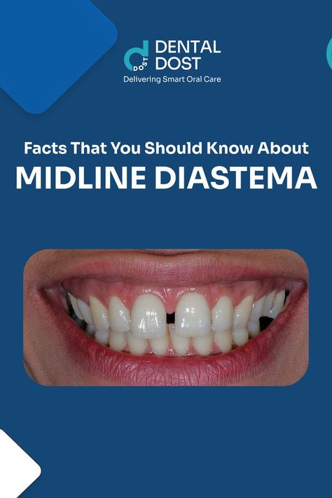 A diastema is a space(gap) between two teeth.
The most common type of diastema is called a midline diastema, which is when the space is between the two front teeth.
It is often a result of genetics but can be caused by orthodontic habits in childhood or accidents.
It can affect both children and adults, but not every adult has had this gap since childhood.
It is more common in females than in males.
If you have midline diastema, you are in good company! Holistic Dentistry, Dental Bonding, Getting Braces, Gap Teeth, Straight Teeth, Front Teeth, Dental Veneers, Periodontal Disease, In Good Company