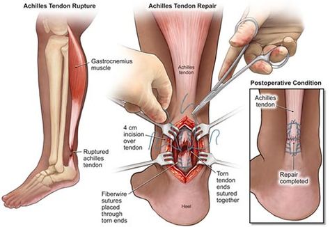 The Achilles tendon is prone to injury and pain due to the enormous demand the body places on it during physical activity and certain anatomical factors that leave it less able to repair itself after injury. Most cases of Achilles pain can be treated through physical therapy and orthotics but when the tendon becomes torn, ruptured or has developed significant scar tissue then Achilles Tendon Surgery becomes an option to discuss with your doctor. Achilles Tendon Repair Recovery, Achilles Tendon Ruptures, Achilles Pain, Ligaments And Tendons, Achilles Tendon, Ankle Pain, Medical Anatomy, Surgery Recovery, Scar Tissue