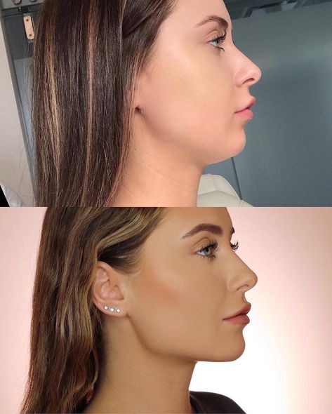 Skin by Lovely™ on Instagram: “repost from @kristinaxmakeup :  Side profile snatched 🔪🔪 so hard! 🤭🤫 I’ve always had a defined jawline until I gained a ton of weight and…” Non Surgical Jawline, Jaw Filler, Snatched Jawline, Snatched Face, Chin Filler, Rhinoplasty Nose Jobs, Face Fillers, Face Surgery, Side Profiles