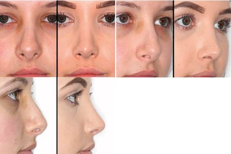 The tip in rhinoplasty | ENT & Audiology News Tip Rhinoplasty, Tall Nose, Calvin Johnson, Facial Fillers, Facial Plastic Surgery, Nose Shapes, Tall People, Facial Plastic, Short People