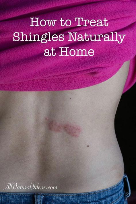 #RemediesForCold Oils For Shingles, Shingles Remedies, Home Remedies For Rashes, Essential Oils For Shingles, Treating Shingles, Shingles Relief, Home Remedies For Skin, Sick Remedies, Natural Cough Remedies