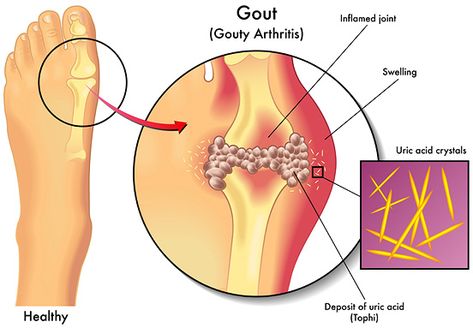 Homeopathic Medicine for Relief from the Pain of Gout - Vitality Magazine Uric Acid Crystals, New Knowledge, Ankle Pain, Uric Acid, Essential Oil Benefits, Homeopathic Medicine, Health Ideas, How To Eat Less, Herbs And Spices